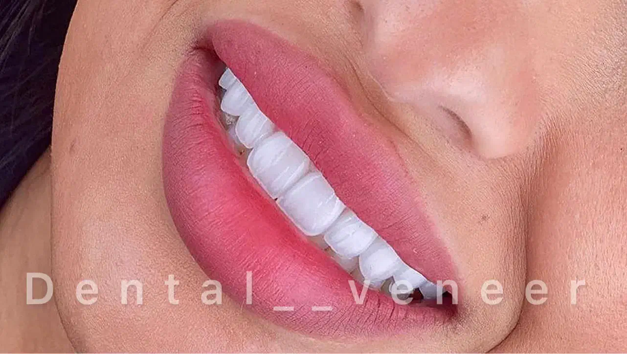 دندانپزشکی لمینت الهیه منطقه ۱ کامپوزیت سرامیکی|خدمات آرایشگری و زیبایی|تهران, الهیه|دیوار