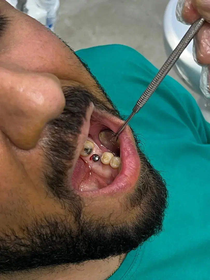 عصب کشی کانالی ۲/۵۰۰ روکش دندان در شرق تهران|خدمات زیبایی و سلامت|تهران, چهارصد دستگاه|دیوار