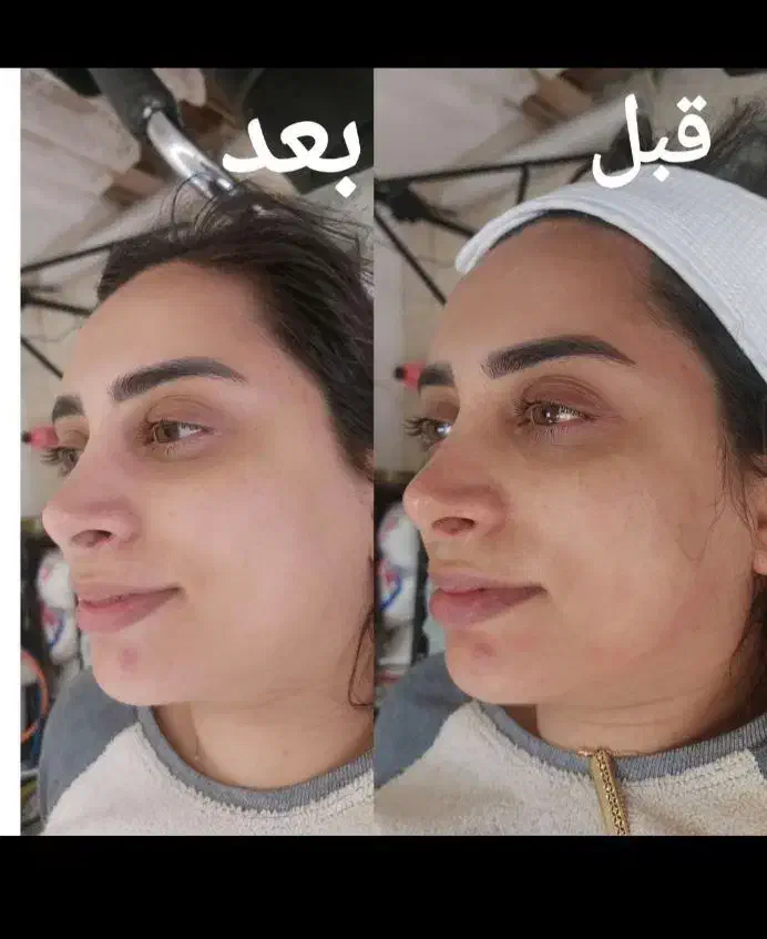 اموزش وخدمات تخصصی پوست باتخفیف بلک فرایدی|خدمات آرایشگری و زیبایی|تربت جام, تیپ ۳۸ زرهی تربت جام|دیوار