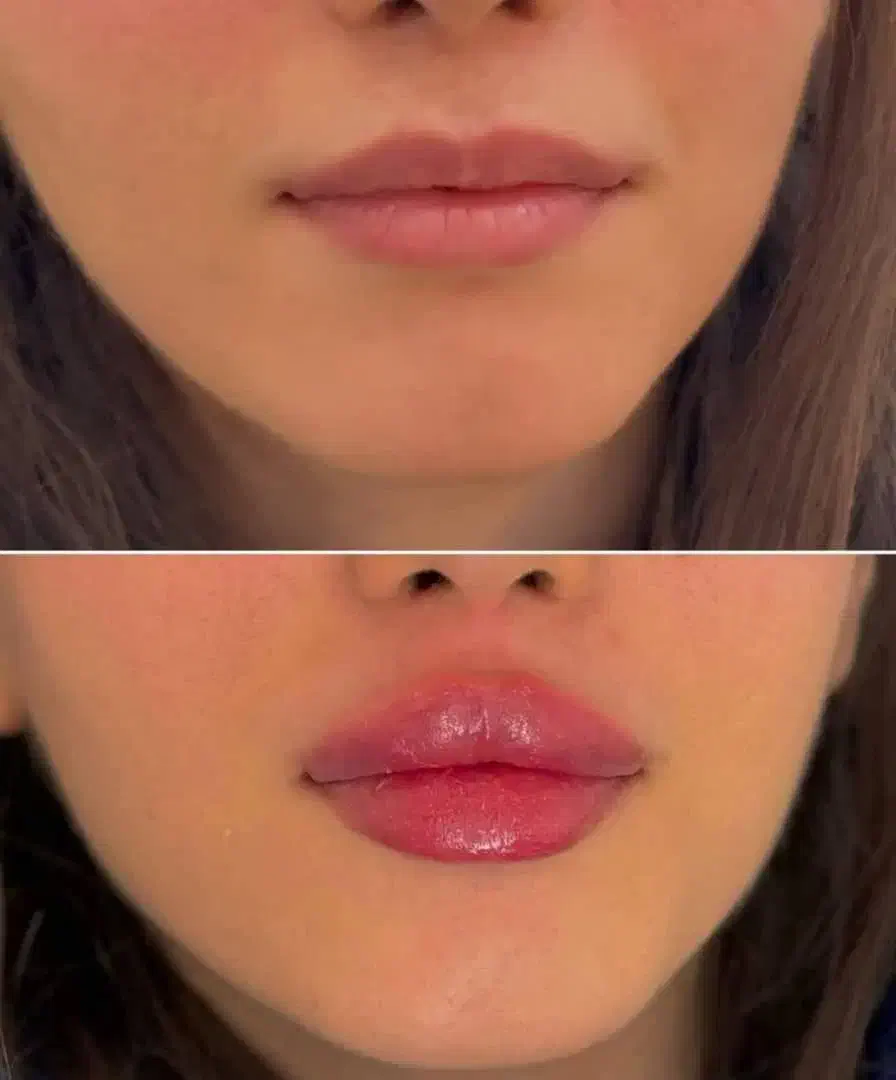 جشنواره ۵۰ درصدی ژل بوتاکس فقط تا سه روز|خدمات آرایشگری و زیبایی|اصفهان, برازنده|دیوار