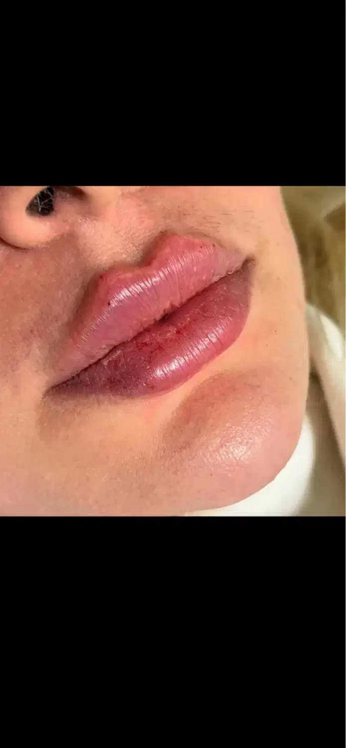 تزریق ژل و انواع مزو ژل های جوانساز|خدمات آرایشگری و زیبایی|بوشهر, |دیوار