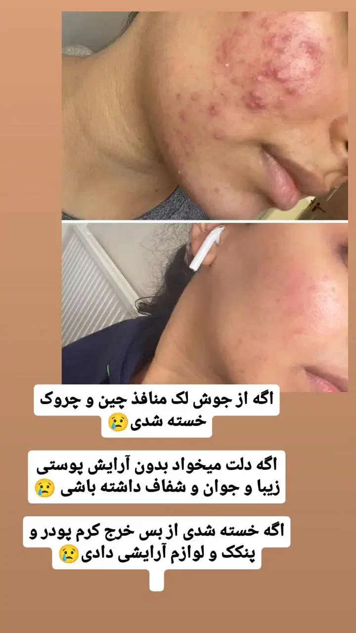 ضد اکنه|آرایشی، بهداشتی، درمانی|شیراز, آبیاری|دیوار