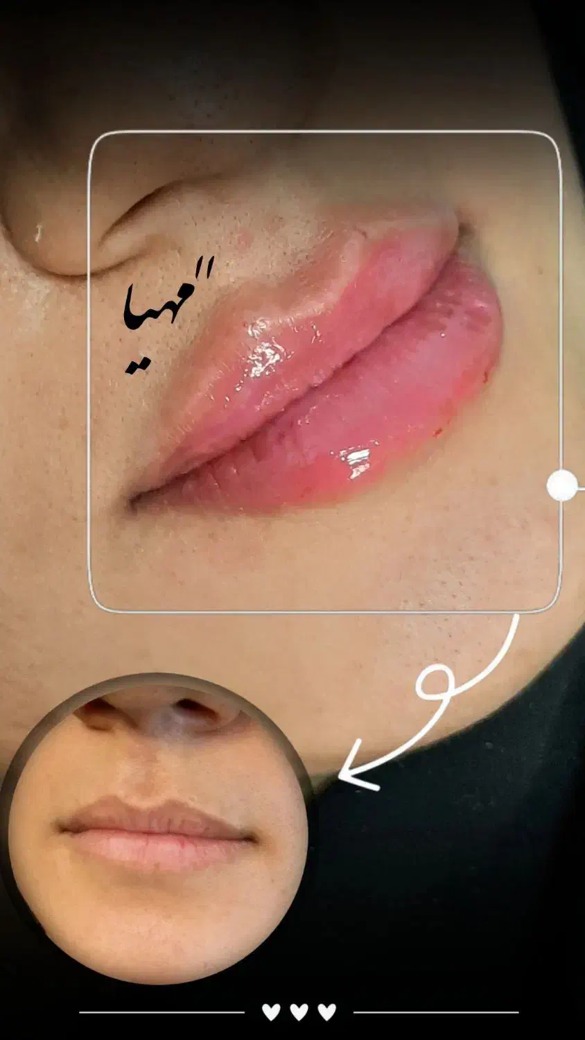 فیلر و بوتاکس وانزیم فیلر|خدمات آرایشگری و زیبایی|قم, دروازه چوبی|دیوار