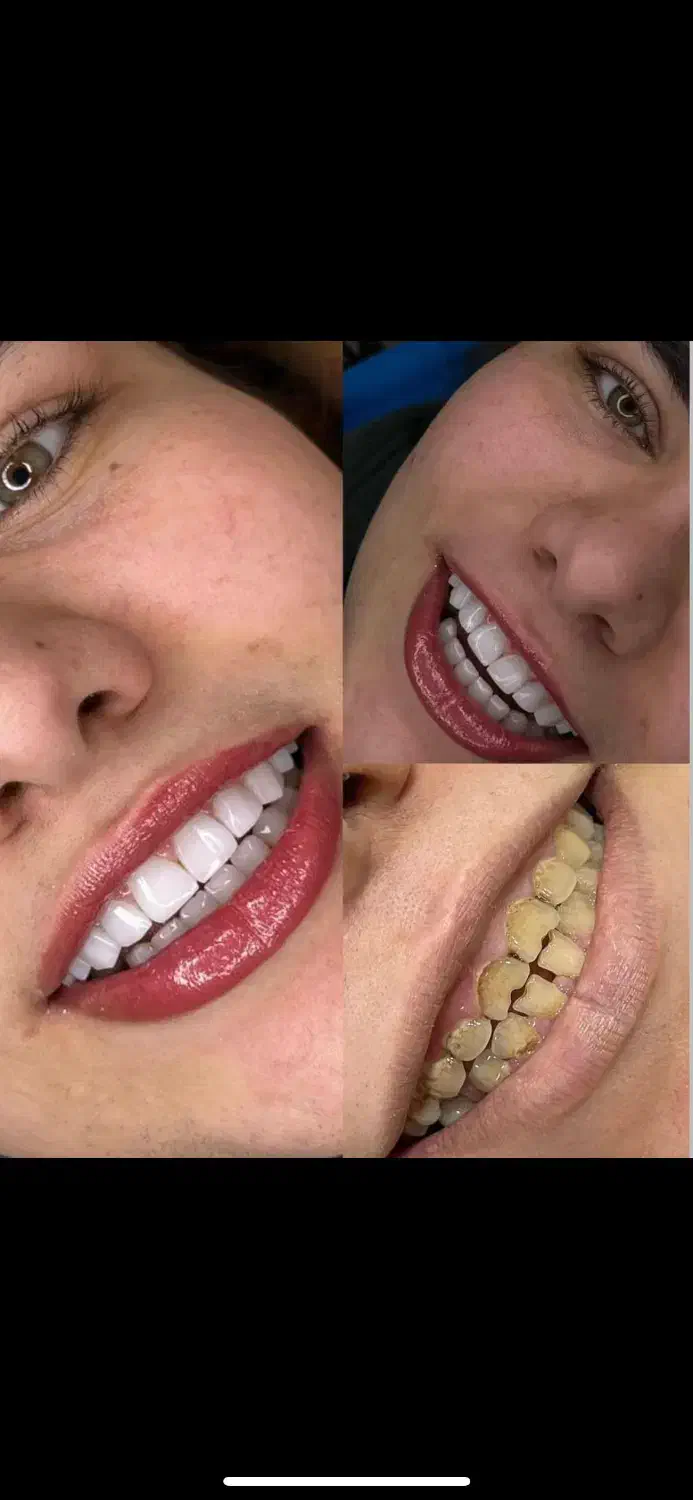 کامپوزیت ونیر آلمانی|خدمات آرایشگری و زیبایی|تهران, چیذر|دیوار