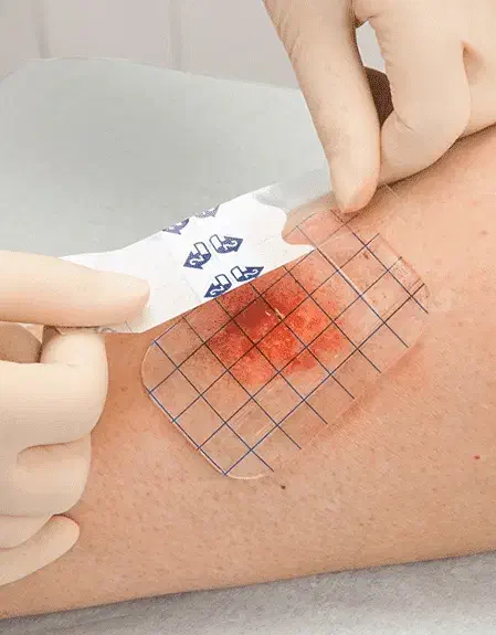 پانسمان نوین زخم بستر / دیابتی / سوختگی / سرطانی|خدمات آرایشگری و زیبایی|ارومیه, |دیوار