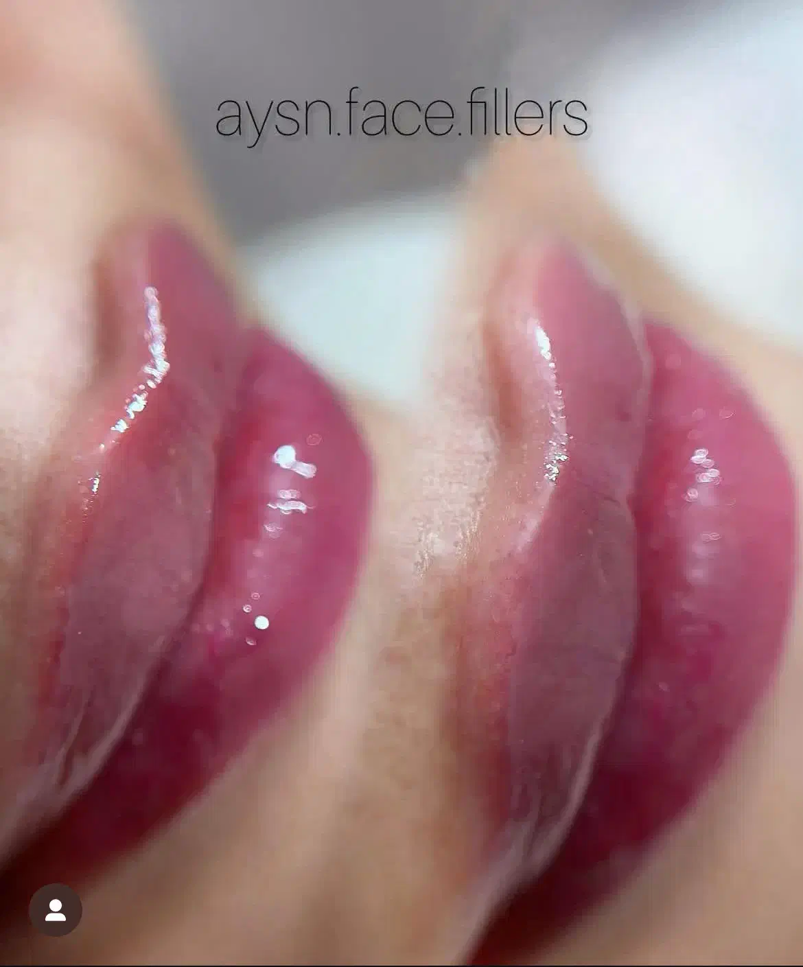 تزریق ژل و بوتاکس  تخفیف ویژه تا اخر هفته جدید|خدمات آرایشگری و زیبایی|گنبد کاووس, |دیوار