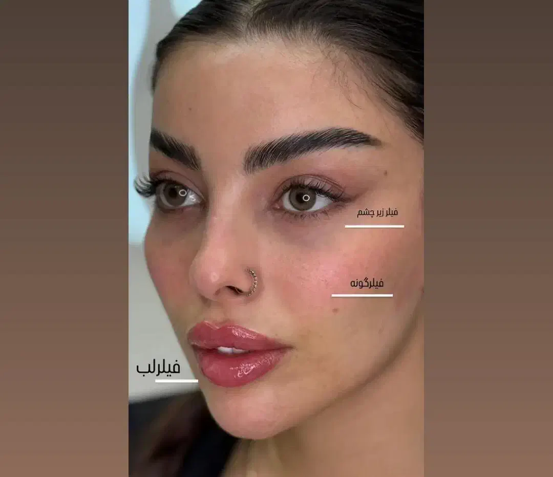 ژل لب مادلینگ کانتورینگ بوتاکس فیلرزیرچشم فیلربادی|خدمات آرایشگری و زیبایی|تهران, سید خندان (جلفا)|دیوار
