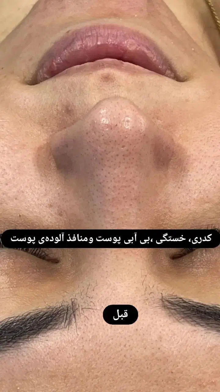 فشیال تخصصی پوست|خدمات آرایشگری و زیبایی|مرند, |دیوار