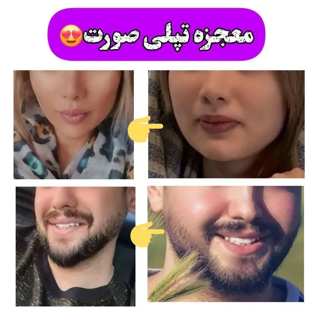 پک چاقی صورت بدون بازگشت و عوارض|آرایشی، بهداشتی، درمانی|ارومیه, |دیوار