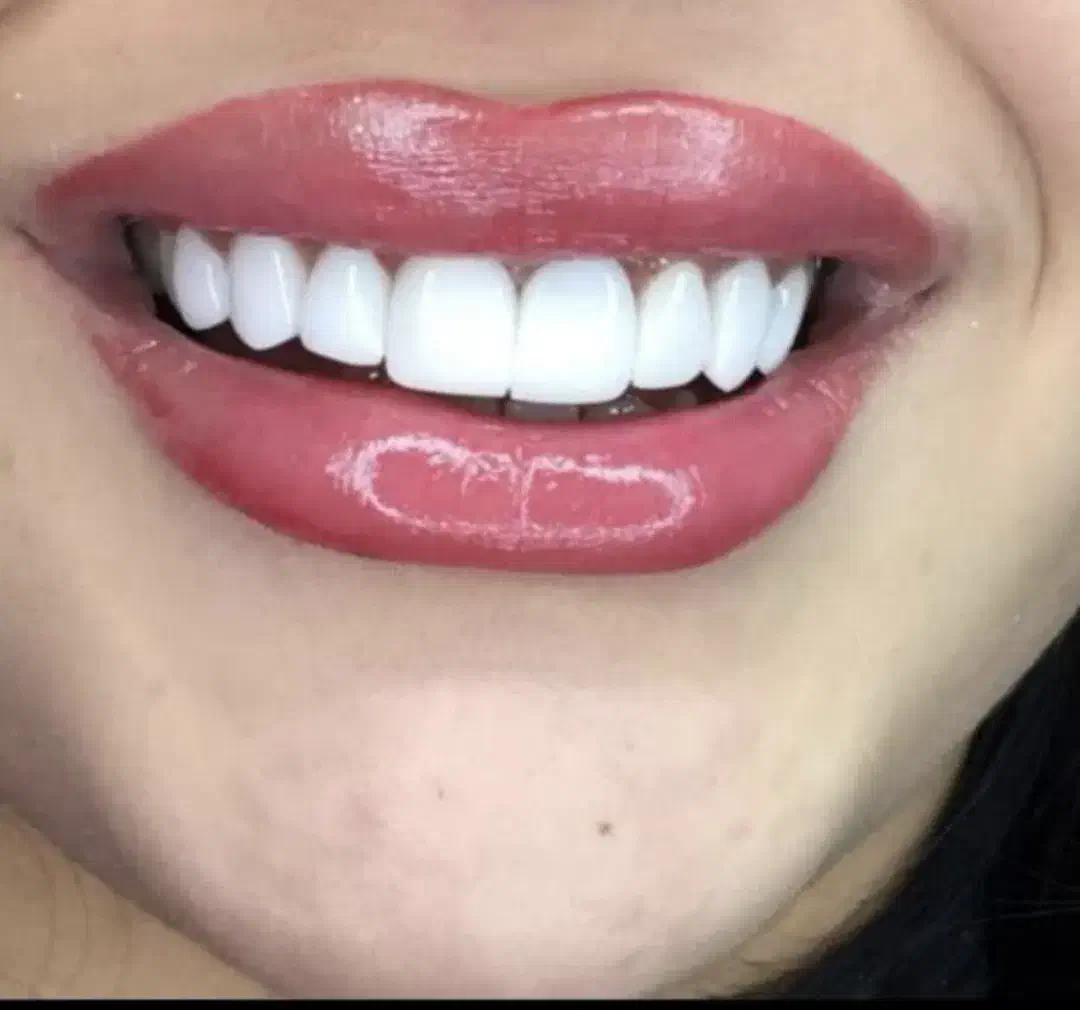 عصب کشی کامپوزیت|خدمات آرایشگری و زیبایی|بروجرد, |دیوار