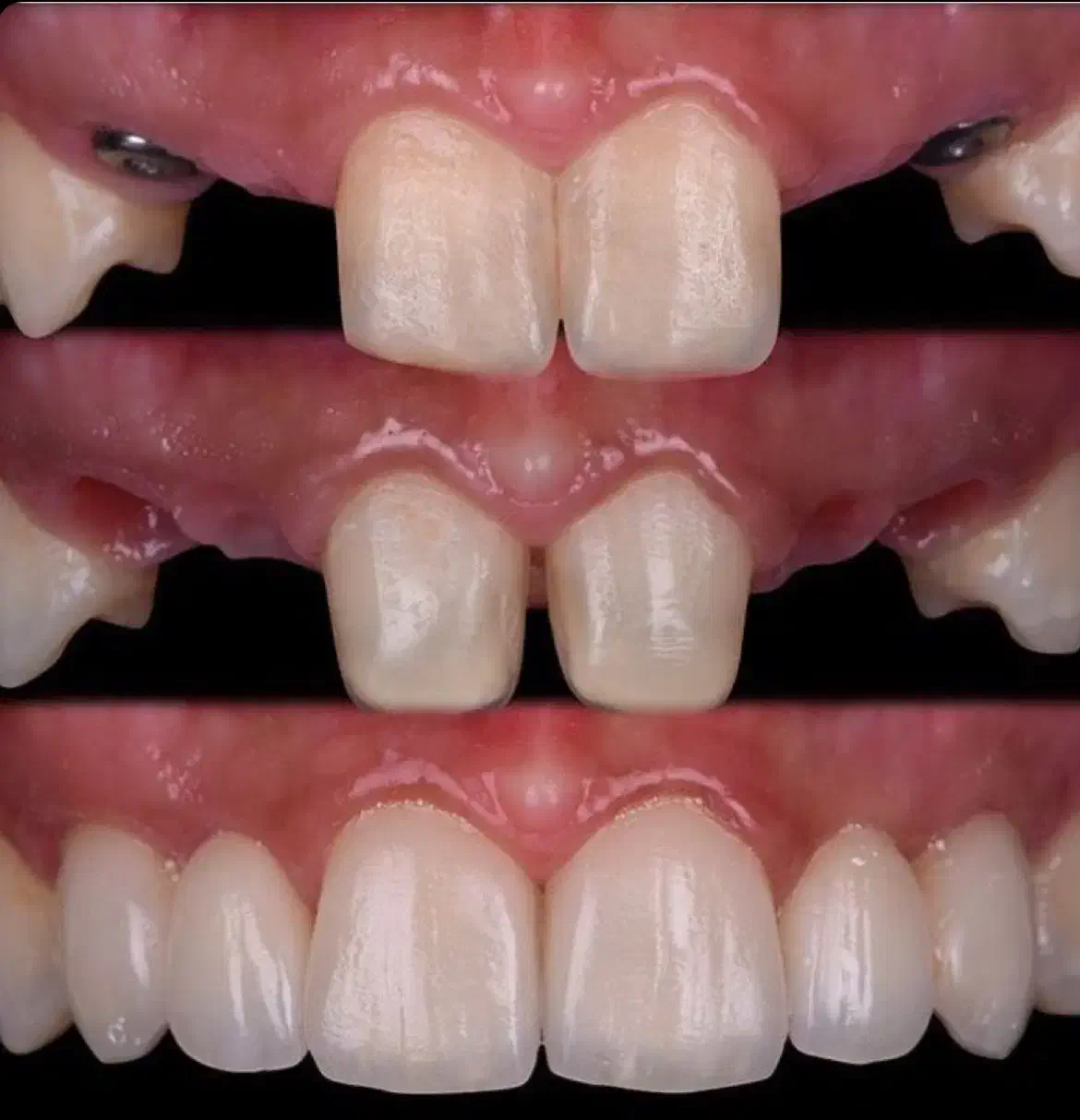 ایمپلنت دندان کره ای و سوئیسی با تخفیف پاییزه|خدمات آرایشگری و زیبایی|قرچک, پارس سرام|دیوار