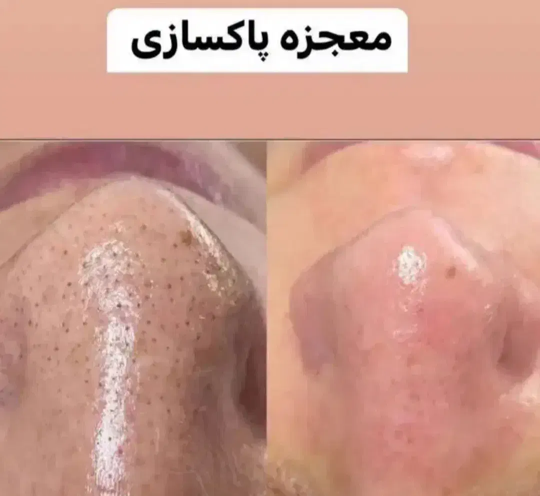 پاکسازی و فیشال پوست|خدمات آرایشگری و زیبایی|میبد, |دیوار