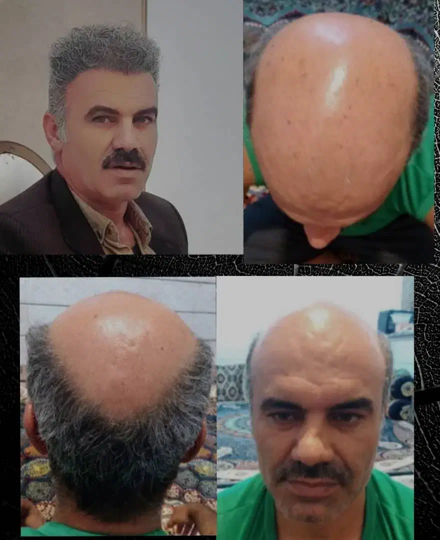 کاشت مو.ابرو.ریش.فول تراکم با شرایط استثنایی|خدمات آرایشگری و زیبایی|شیراز, ستارخان|دیوار