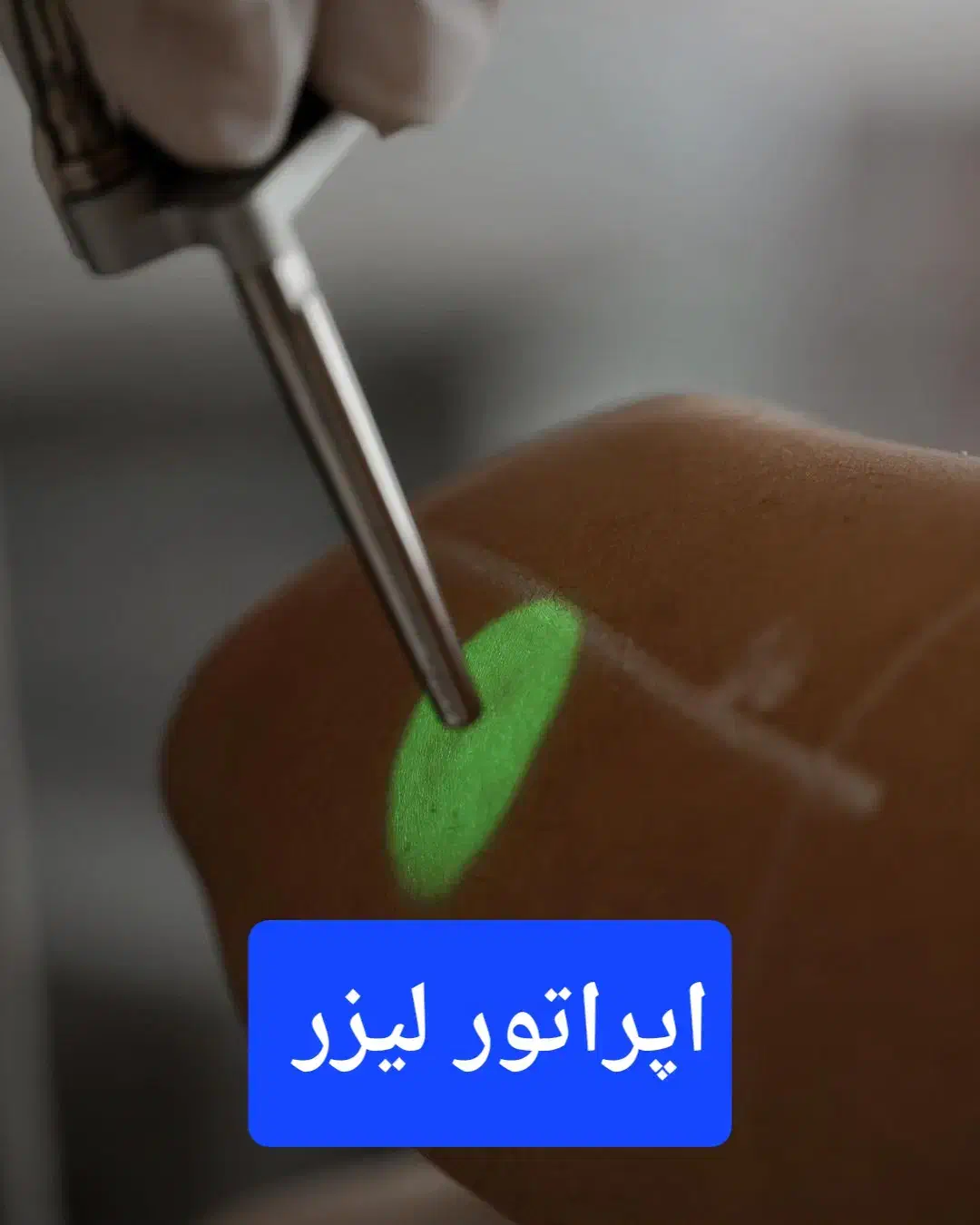 استخدام مطب لیزر قائم شهر|استخدام درمانی، زیبایی، بهداشتی|قائم‌شهر, |دیوار