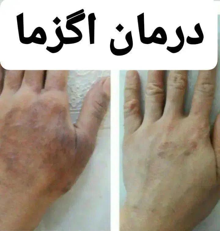 عدد بیماریت رو بگو ودرمان رو با کمک ما شروع کن|خدمات آرایشگری و زیبایی|بندرلنگه, |دیوار