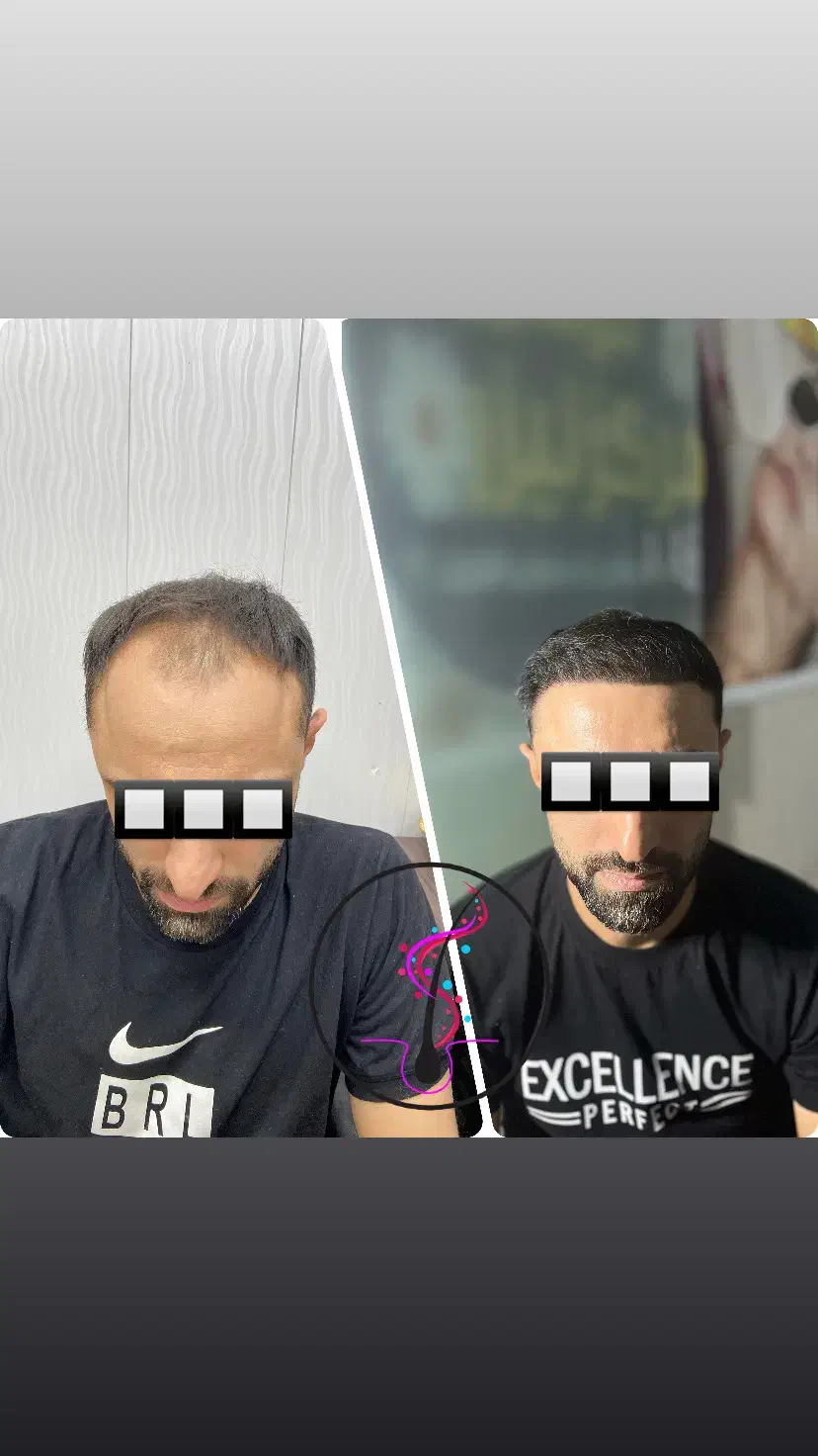 کاشت مو با شرایط اقساط تضمینی|خدمات آرایشگری و زیبایی|اردبیل, |دیوار