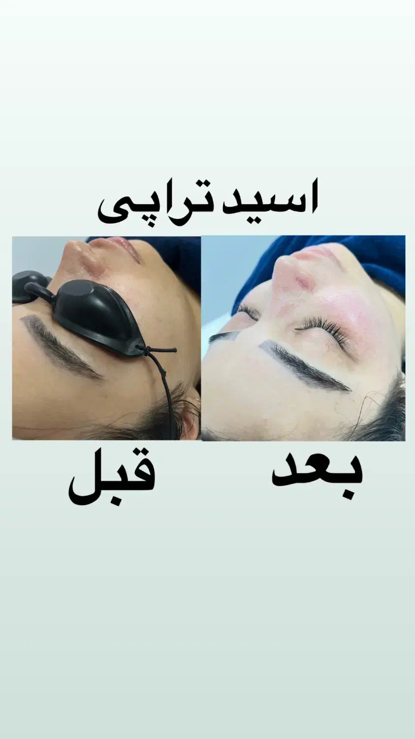 پاکسازی پوست به صورت حرفه ای فقط ۴۰۰ت|خدمات آرایشگری و زیبایی|قائمشهر, |دیوار