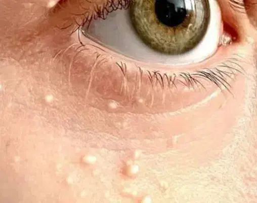 درمان کیست ملیا زیر چشم و برداشتن خال و زگیل|خدمات آرایشگری و زیبایی|نیشابور, دارایی|دیوار