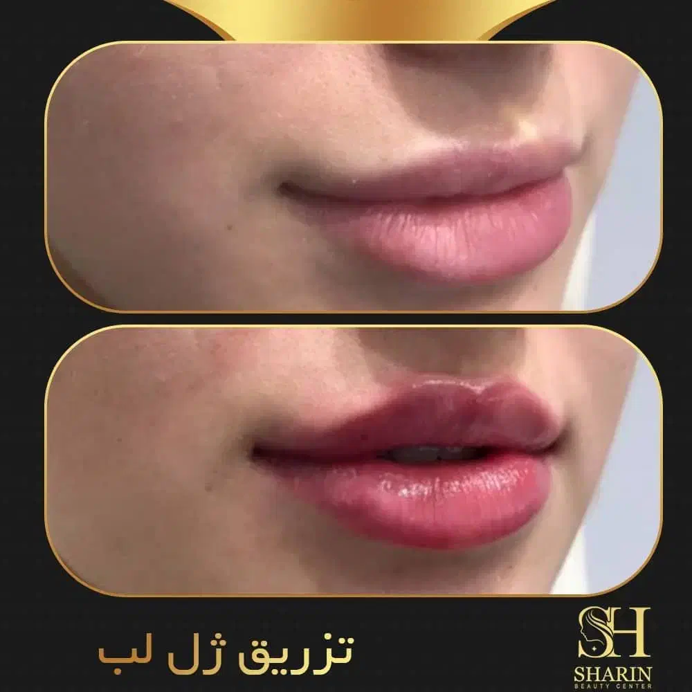 تزریقات زیبایی ژل،بوتاکس،هایفوتراپی،مزوتراپی وفیلر|خدمات آرایشگری و زیبایی|تهران, جنت‌آباد جنوبی|دیوار