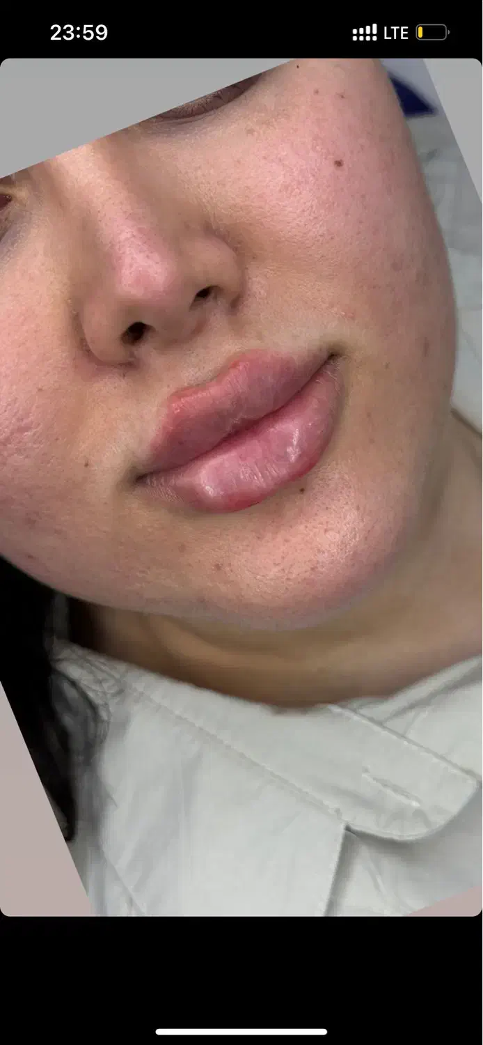 ژل بوتاکس ژل لب فیلرزیر چشم مزوتراپی مزوژل|خدمات آرایشگری و زیبایی|شیراز, کاراندیش|دیوار