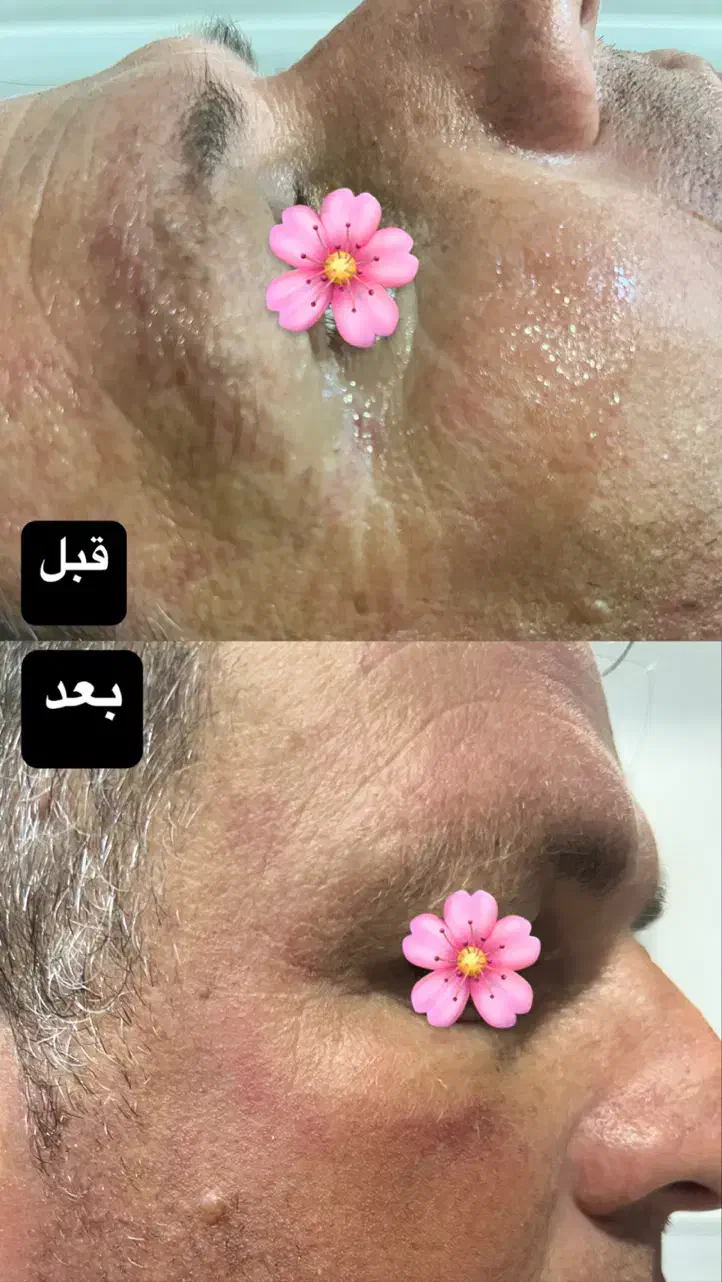 جشنواره زیبایی پوست با هایفوتراپی و آر اف فرکشنال|خدمات آرایشگری و زیبایی|قم, دورشهر|دیوار