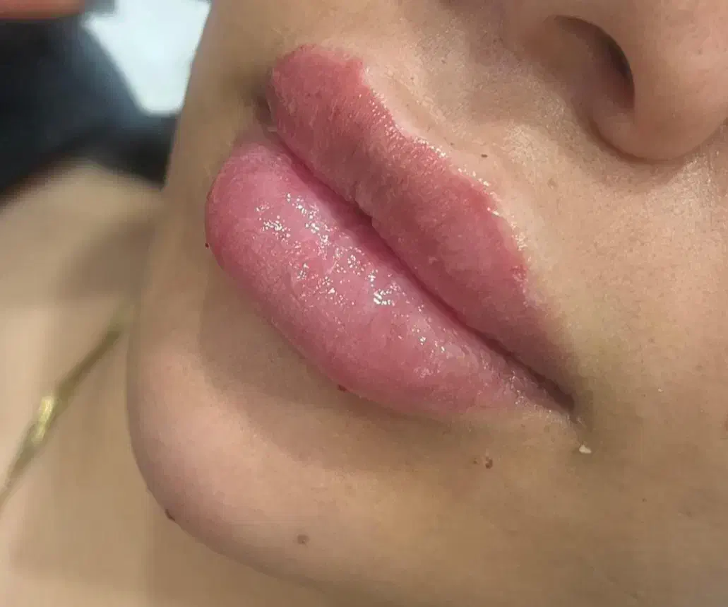 تزریق ژل|خدمات آرایشگری و زیبایی|یاسوج, |دیوار