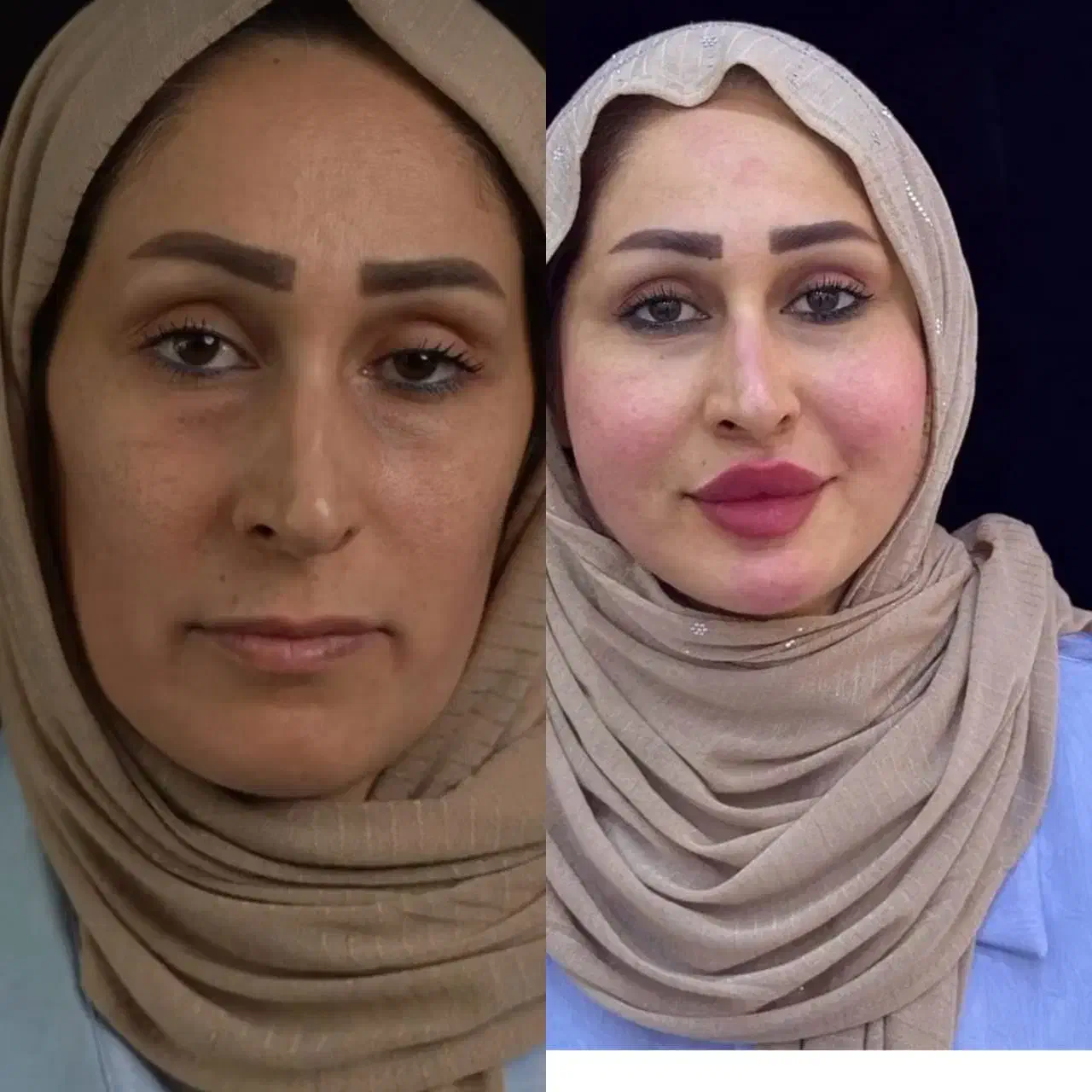 ده سی سی فیلر ،برند معتبر فقط ۵ میلیون|خدمات آرایشگری و زیبایی|تهران, ایوانک|دیوار