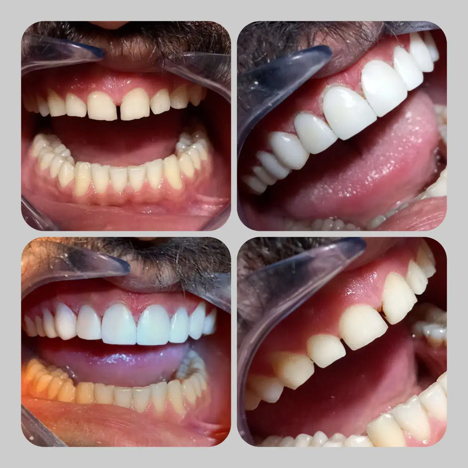 کامپوزیت زیبایی جشنواره ی تخفیفی یلدا|خدمات آرایشگری و زیبایی|کوهدشت, |دیوار