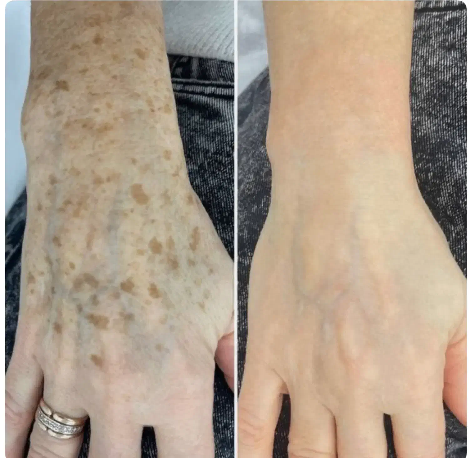 لیزر ، الکترولیز ، روشن سازی ، کک‌ و مک توسط پزشک|خدمات آرایشگری و زیبایی|بندرعباس, |دیوار