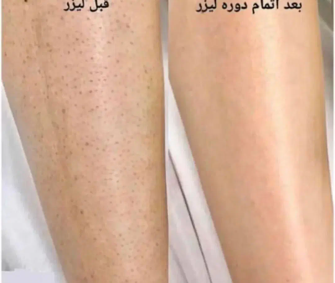 لیزرسوپرانو تیتانیوم با40 درصد تخفیف ، فولبادی 399|خدمات آرایشگری و زیبایی|بندرعباس, |دیوار