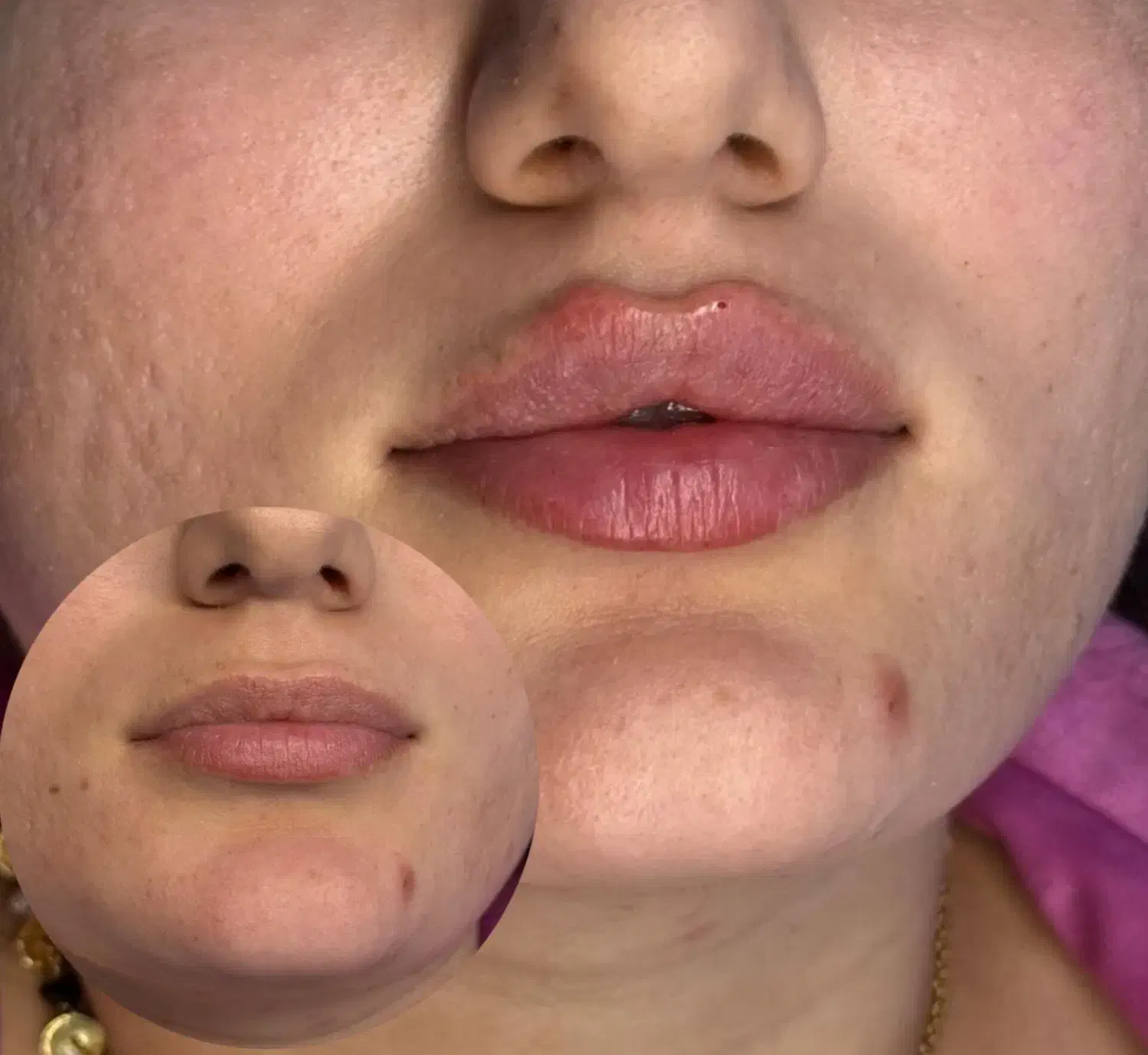 تزریق ژل و بوتاکس|خدمات آرایشگری و زیبایی|رشت, بوسار|دیوار