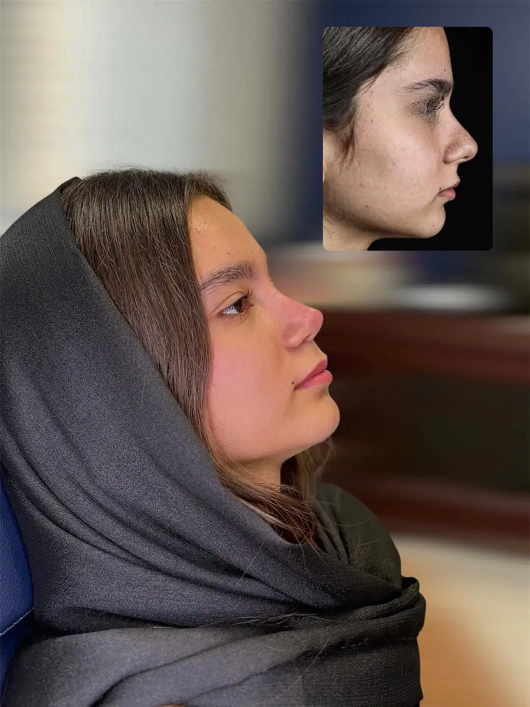 جراحی بینی به سبک پیزوسرجری و با قیمت باورنکردنی|خدمات آرایشگری و زیبایی|ابهر, |دیوار