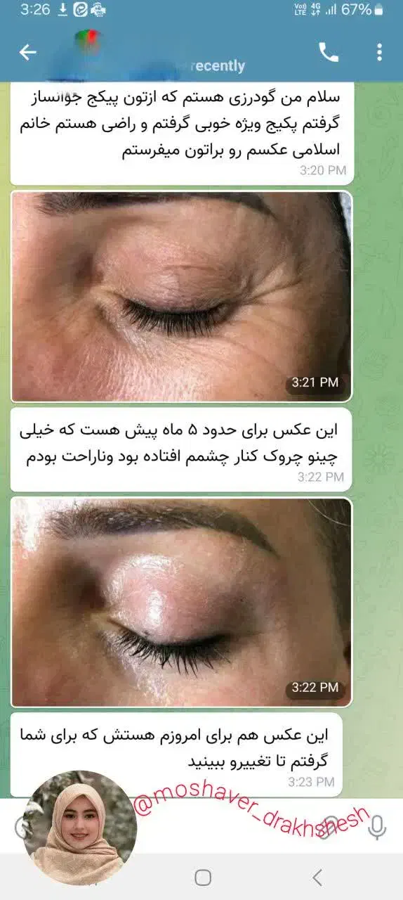 جوانسازی بیومیتیک بدون کار های تهاجمی|آرایشی، بهداشتی، درمانی|تهران, نگین غرب|دیوار