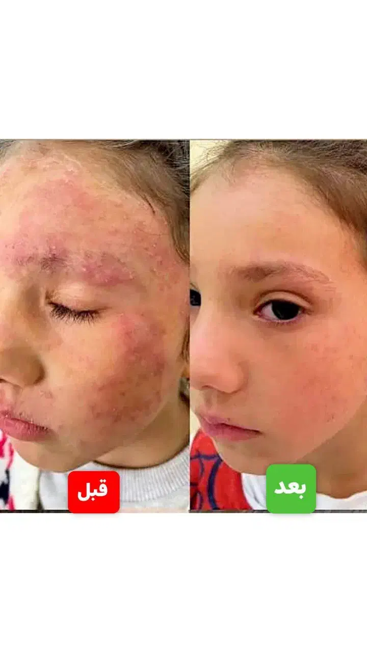 درمان بیماریهای پیسی وپسوریازیس واگزما  دائمی|خدمات آرایشگری و زیبایی|گرگان, |دیوار