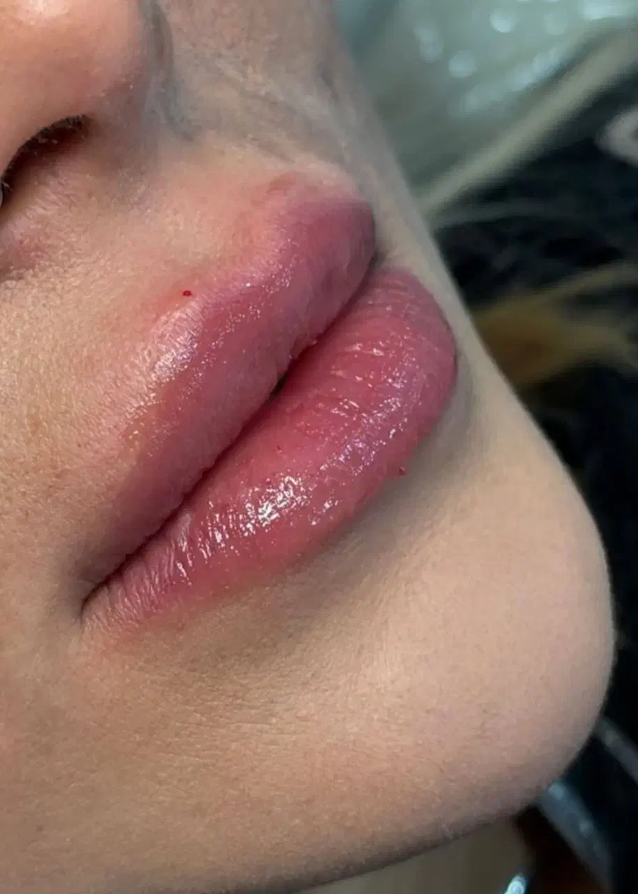 فیلر وبوتاکس|خدمات آرایشگری و زیبایی|گرگان, |دیوار