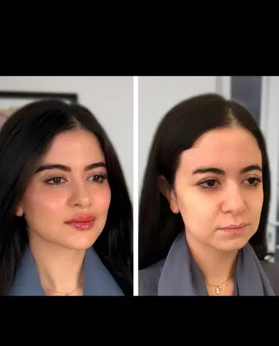 تخفیف تزریق ژل وبوتاکس|خدمات آرایشگری و زیبایی|آمل, |دیوار