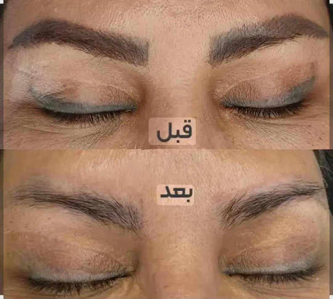 ریموو تتو با متد جدید بدون درد|خدمات آرایشگری و زیبایی|رشت, گلسار|دیوار