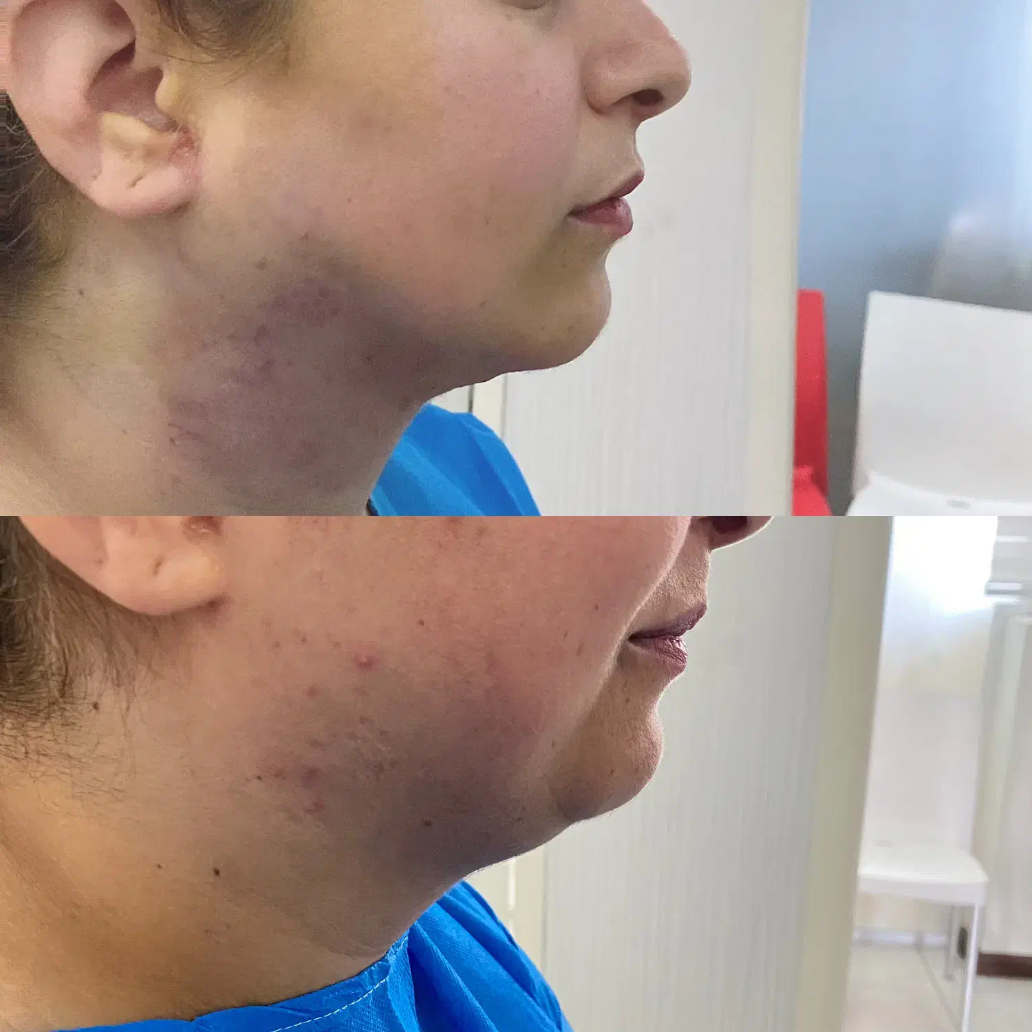 ساکشن غبغب و شکم فیلر بادی پی ار پی ژل و بوتاکس|خدمات آرایشگری و زیبایی|شیراز, قصرالدشت|دیوار