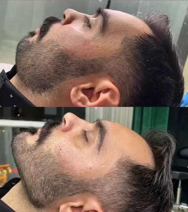 جشنواره پاییزه فیلر لب ژللب بوتاکس زاویه فک گونه|خدمات آرایشگری و زیبایی|کرج, مطهری|دیوار