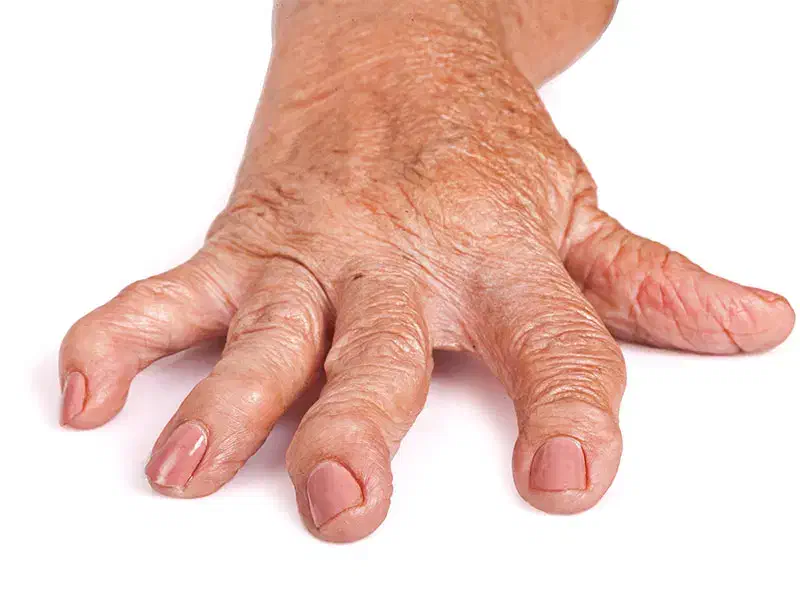 خداحافظی با درد مفاصل ودرد روماتیسم با قدرت طبیعت|خدمات آرایشگری و زیبایی|اردبیل, |دیوار