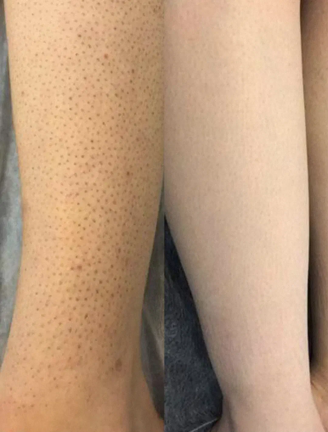 لیزر موهای زائد با 40 درصد تخفیف، فولبادی فقط 399|خدمات آرایشگری و زیبایی|بندرعباس, |دیوار