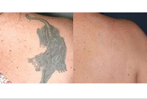 پاک کردن تتو با کیوسوییچ|خدمات آرایشگری و زیبایی|ارومیه, |دیوار