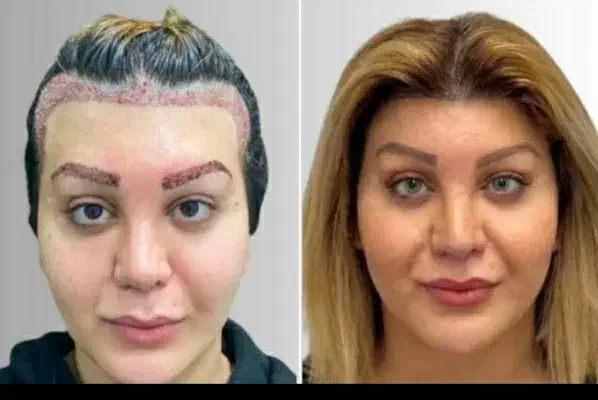 کاشت مو و ابروی طبیعی مزو و پی آرپی جلوگیری ریش مو|خدمات آرایشگری و زیبایی|تبریز, |دیوار