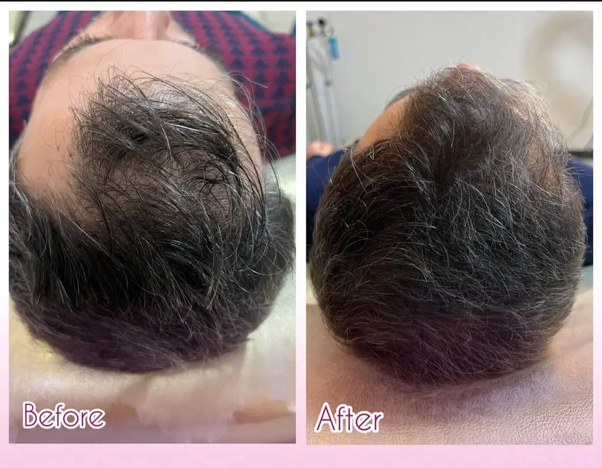 درمان قطعی ریزش مو و رد مجدد مو با پکیج درمانی H3|خدمات آرایشگری و زیبایی|شاهین‌شهر, خانه کارگر|دیوار