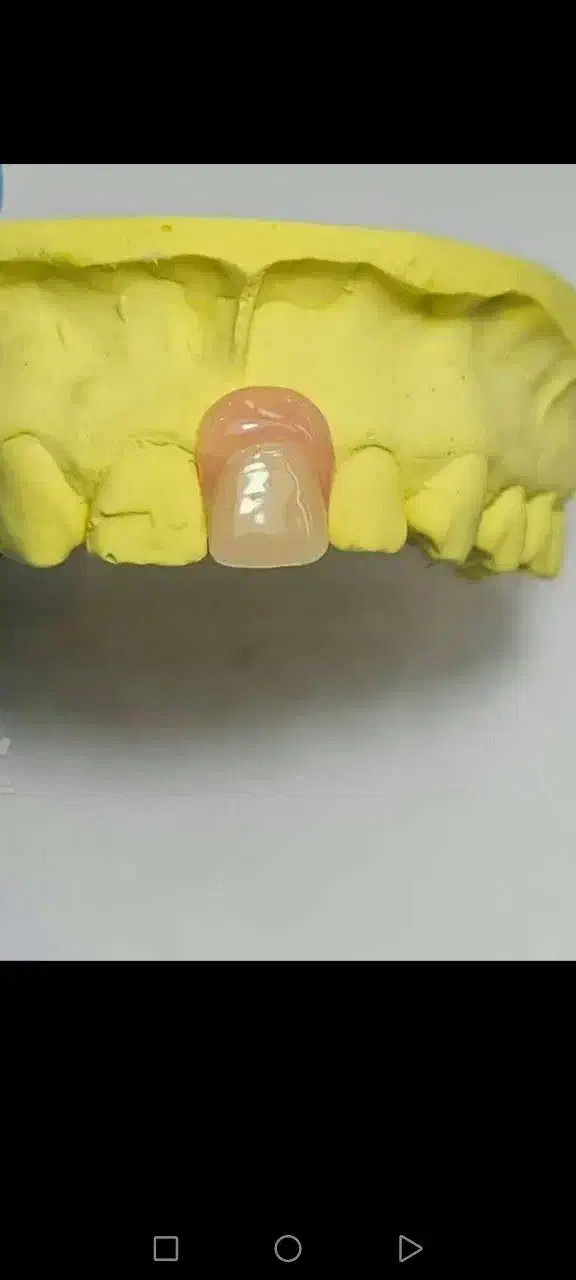 پروتز دندان دندانسازی تضمینی|آرایشی، بهداشتی، درمانی|صفادشت, |دیوار