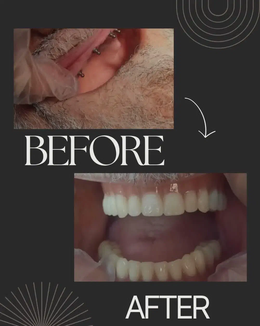 جشنواره کامپوزیت لمینیت عصب IPS IMAX روکش N2 ونیر|خدمات آرایشگری و زیبایی|تهران, هفت حوض|دیوار