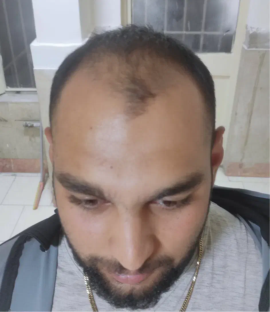 جشنواره کاشت مو و مزوتراپی|خدمات آرایشگری و زیبایی|مشهد, احمدآباد|دیوار