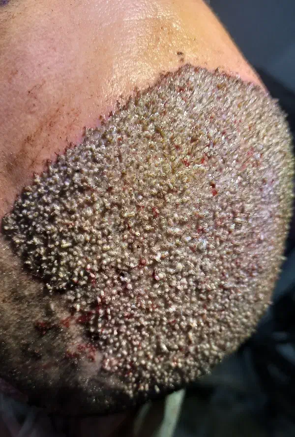 کاشت مو و ابرو با جدید ترین دستگاه های روز دنیا|خدمات آرایشگری و زیبایی|یاسوج, |دیوار