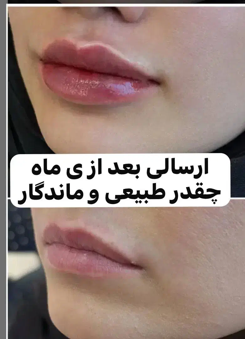 آموزش بوتاکس و فیلر (ژل)|خدمات آموزشی|امیدیه, |دیوار