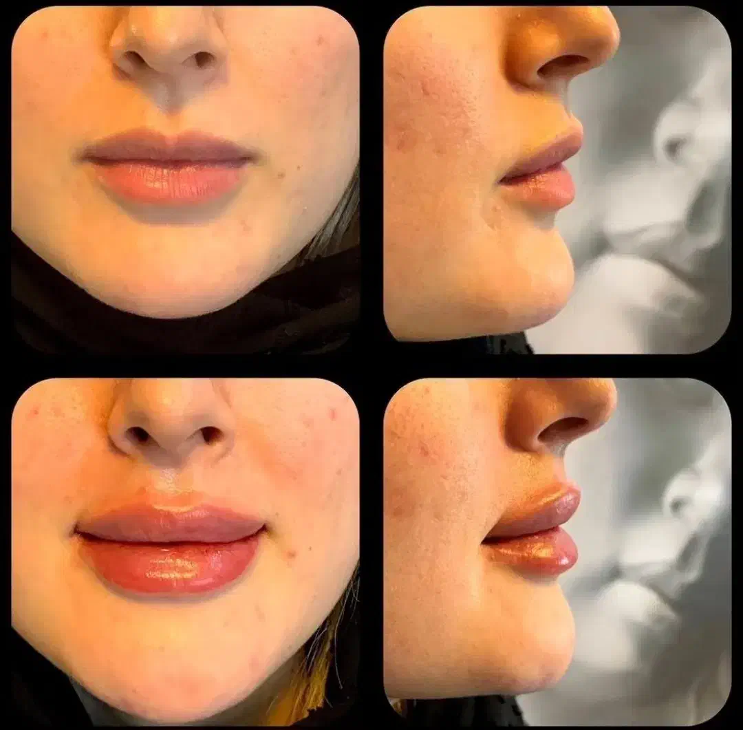 تزریق ژل و فیلر|خدمات آرایشگری و زیبایی|خرم‌آباد, |دیوار